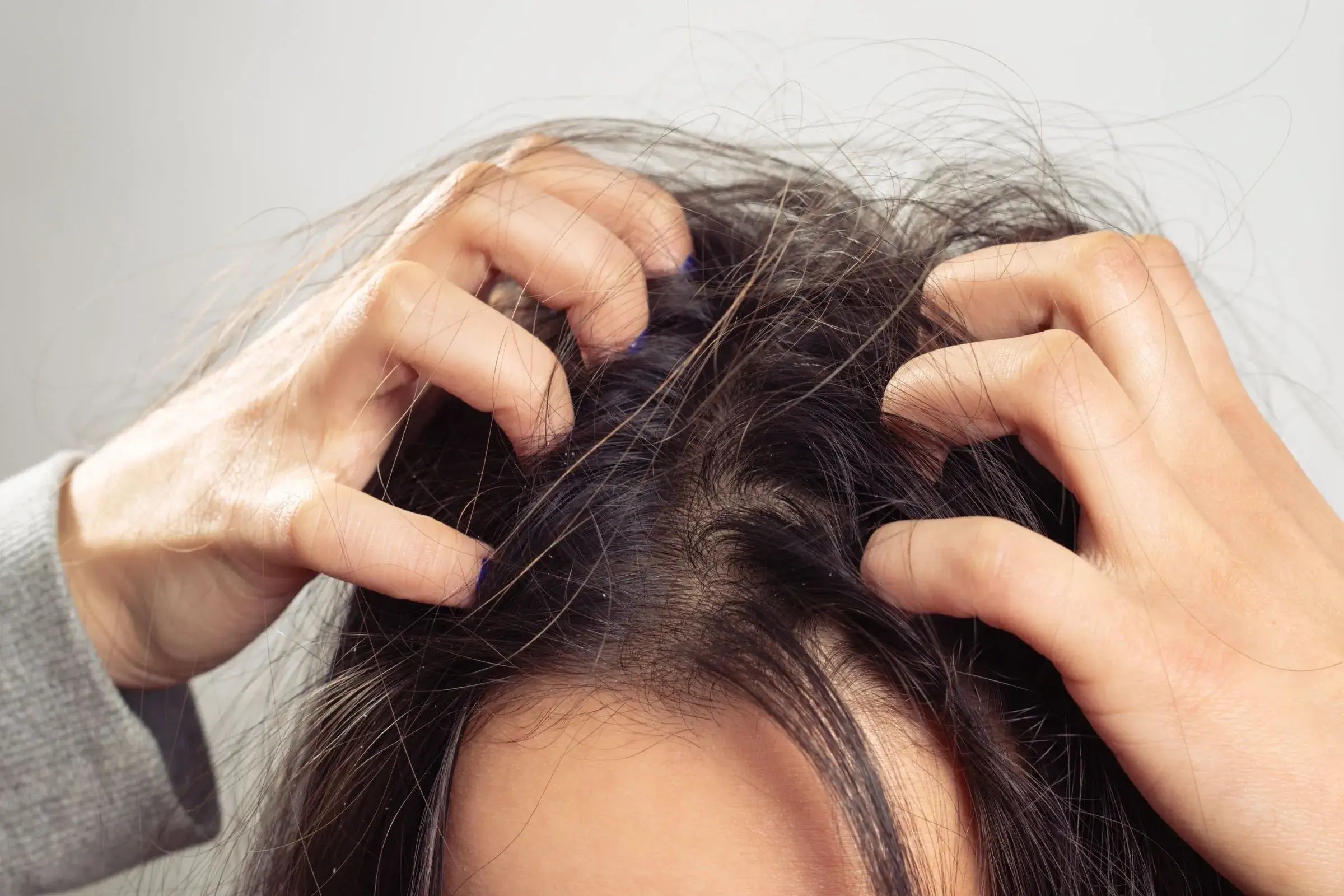 Cover_Photo_100_PURE_Itchy_Scalp_Driving_You_Crazy__Try_These_5_Natural_Remedies